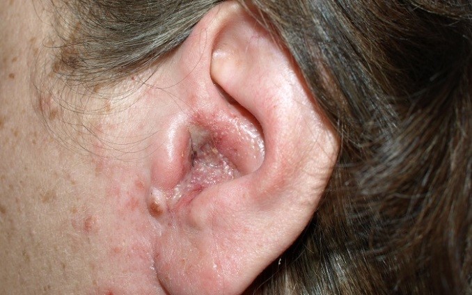 Грибок в ушах (отомикоз): симптомы и лечение