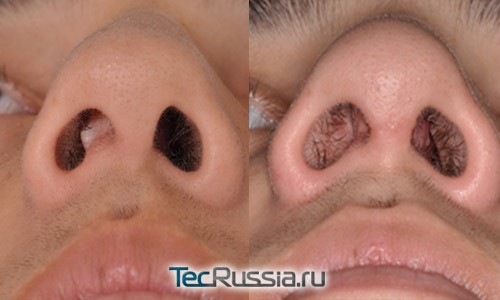 Операция по исправлению искривления носовой перегородки