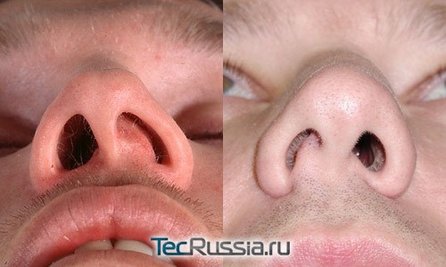Операция по исправлению искривления носовой перегородки