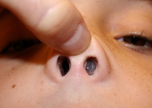 Искривление носовой перегородки: разновидности, причины, симптоматика у взрослых и детей