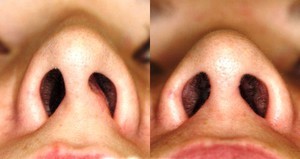 Искривление носовой перегородки: разновидности, причины, симптоматика у взрослых и детей