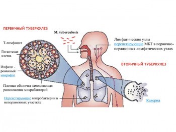 Как передается открытая форма туберкулеза?