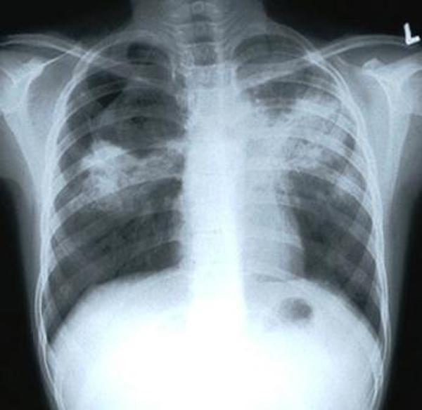 Как проявляется ранняя стадия туберкулеза у мужчин
