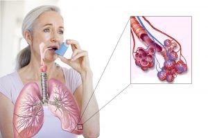 Как лечить одышку при бронхиальной астме?