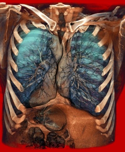 МРТ (магнитно-резонансная томография) бронхов и легких