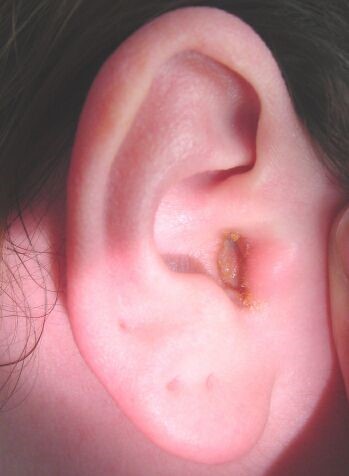 Чем вызвано воспаление внутреннего уха