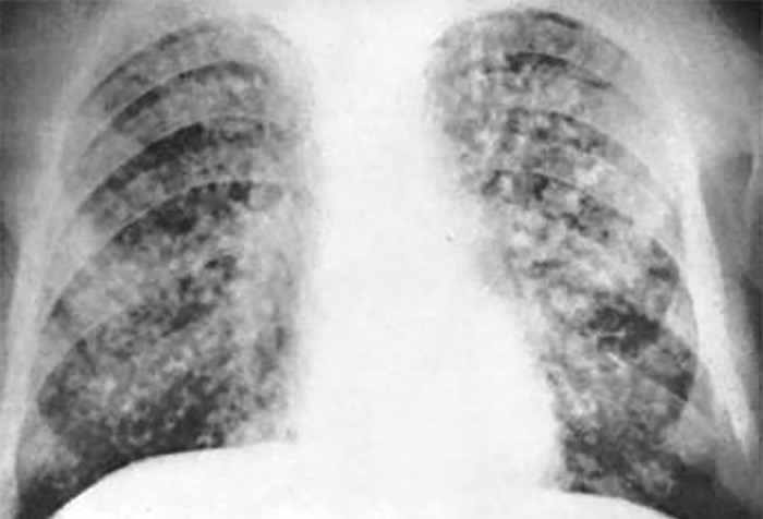 Опасность открытой формы туберкулеза