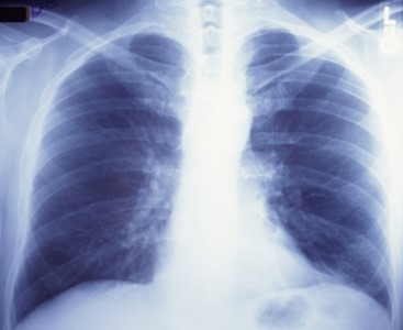 Палочка Коха (mycobacterium tuberculosis) – как передается возбудитель туберкулеза
