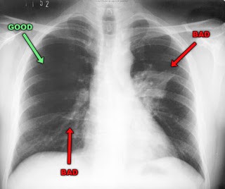 Как выглядит пневмония на рентгеновских снимках?
