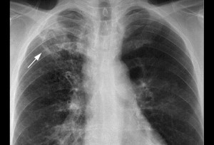 Как выглядит пневмония на рентгеновских снимках?