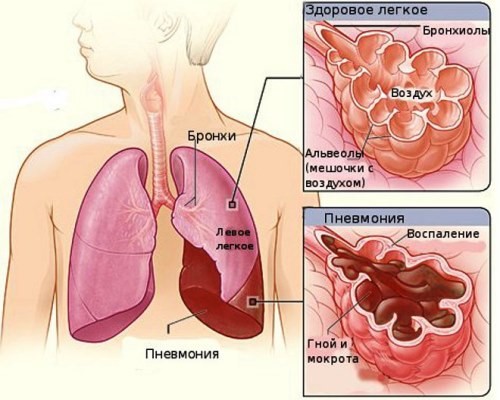 Насколько опасна пневмония?