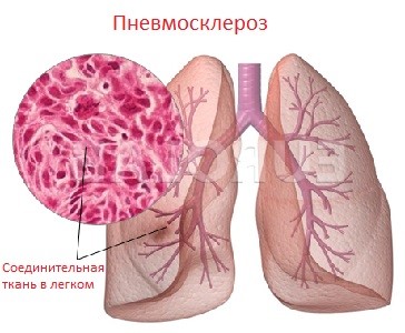 Пневмосклероз легких: причины и способы лечения