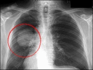 Флюорография при раке легких: покажет ли патологию?