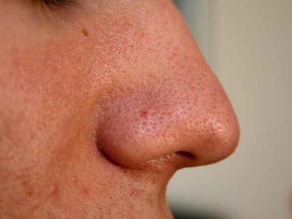 Причины и основные методы лечения фурункула в носу