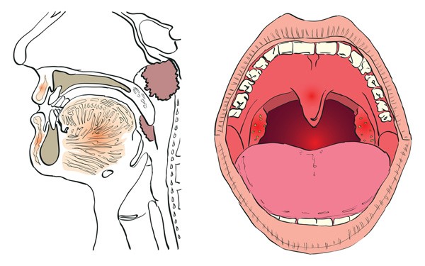 Болезни горла и гортани – причины, симптомы, лечение и профилактика