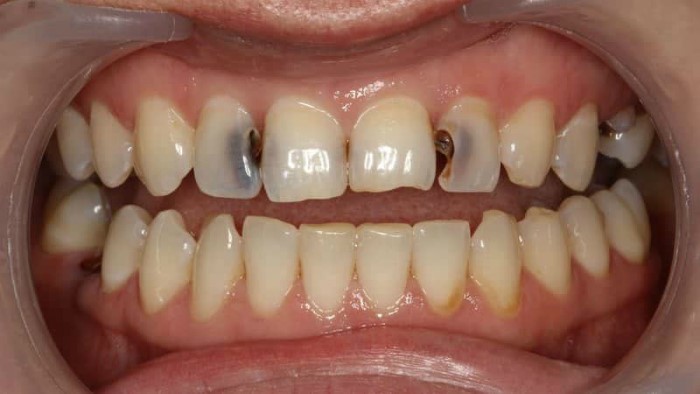 Полоскание зубов содой и солью при боли