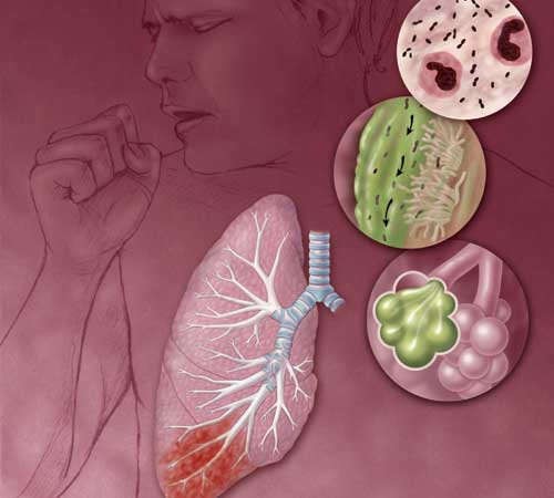Как лечить сегментарную пневмонию у взрослых и детей