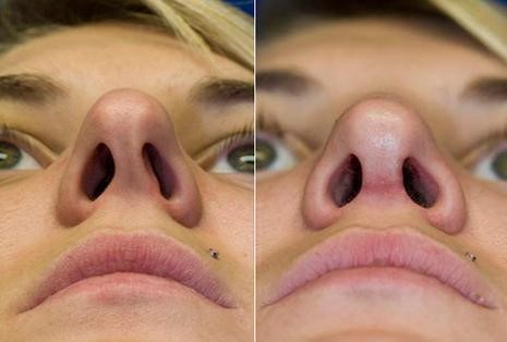 Септопластика носовой перегородки