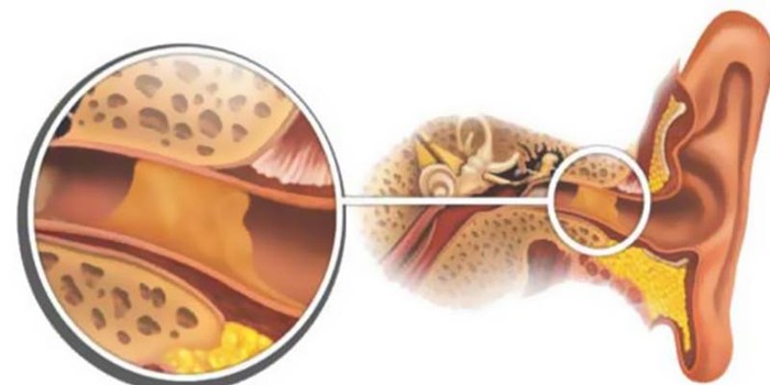 Ушная пробка: причины появления и основные симптомы