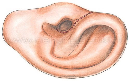 Стапедопластика - операция при отосклерозе уха