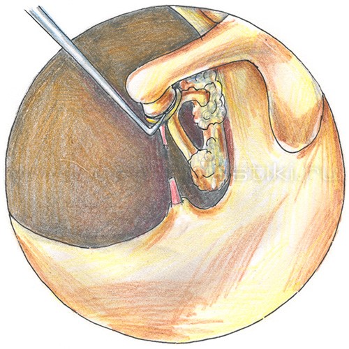 Стапедопластика - операция при отосклерозе уха