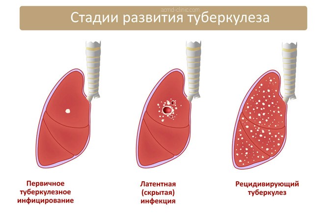 Туберкулема легких - что это такое и как выполнять лечение