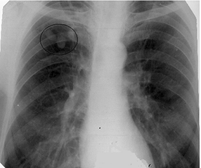 Туберкулема легких - что это такое и как выполнять лечение