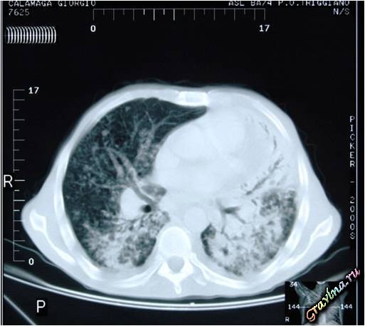 Туберкулез легких: активные и неактивные формы