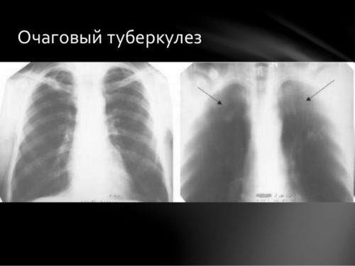 Симптомы туберкулеза легких у взрослых женщин признаки на ранней стадии фото