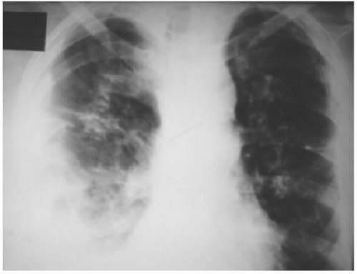 Туберкулез: формы, проявления, признаки