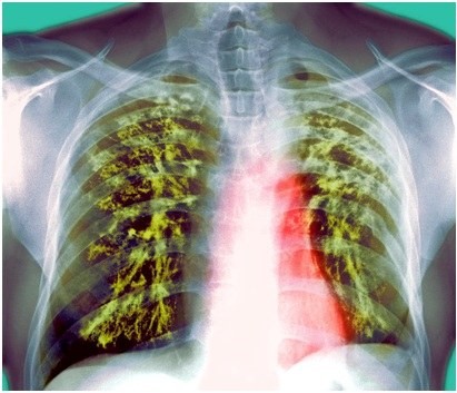 Стадии, виды и формы туберкулеза легких