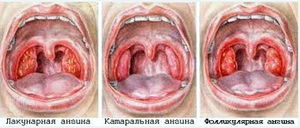 Сопли в горле: как избавиться и основные причины их появления
