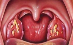 Почему возникают белые комочки в горле и их лечение