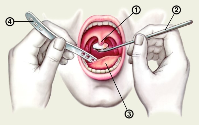 Воспаление язычка в горле (увулит)
