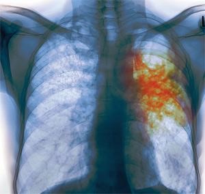 Болезни легких и их симптомы: возможные патологии и их проявления