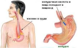 Жжение в горле: причины, симптомы, лечение