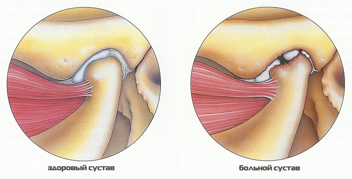 Причины, признаки и лечение артрита височно нижнечелюстного сустава