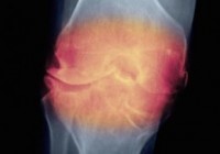 Воспаление суставов: причины и борьба с болью