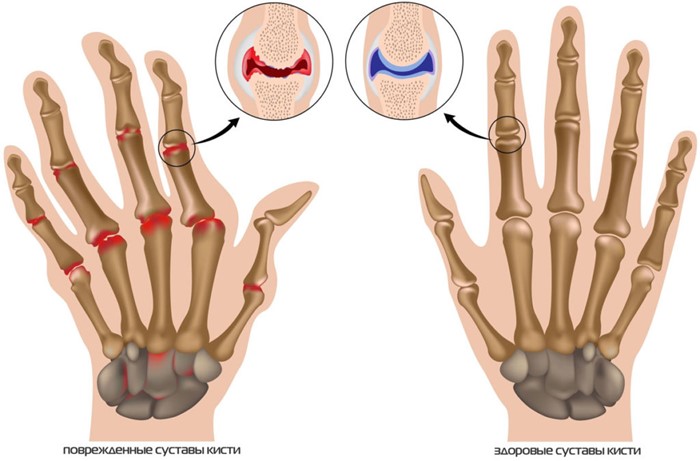Как распознать и лечить артроз пальцев рук