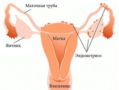Боль внизу спины слева у женщин