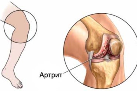Боль в колене при разгибании ноги: почему больно разгибать сустав