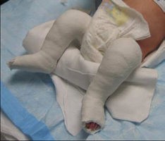 Дисплазия тазобедренных суставов у новорожденного младенца: фото грудничка