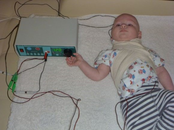 Электрофорез при дисплазии тазобедренных суставов у детей