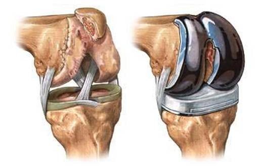Эндопротезирование коленного сустава: реабилитация после операции, осложнения