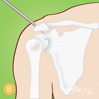 Внутрисуставные инъекции в коленный и тазобедренный суставы: техника введения уколов, обзор препаратов