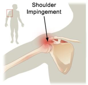 Импинджмент-синдром плечевого сустава