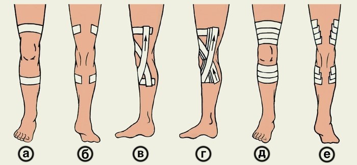 Повязка на колено: эластичная повязка на коленный сустав