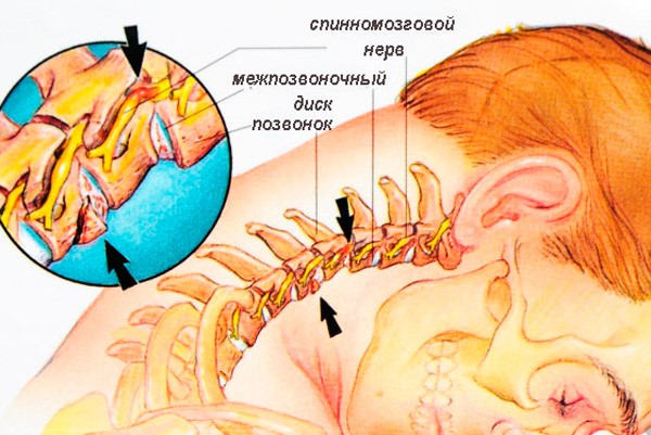 Головная боль при шейном остеохондрозе и как от нее избавиться