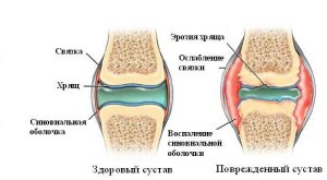 Лечение синовита коленного сустава в домашних условиях