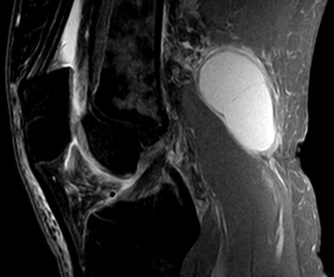 Киста Бейкера коленного сустава: как лечить кисту под коленом (фото)